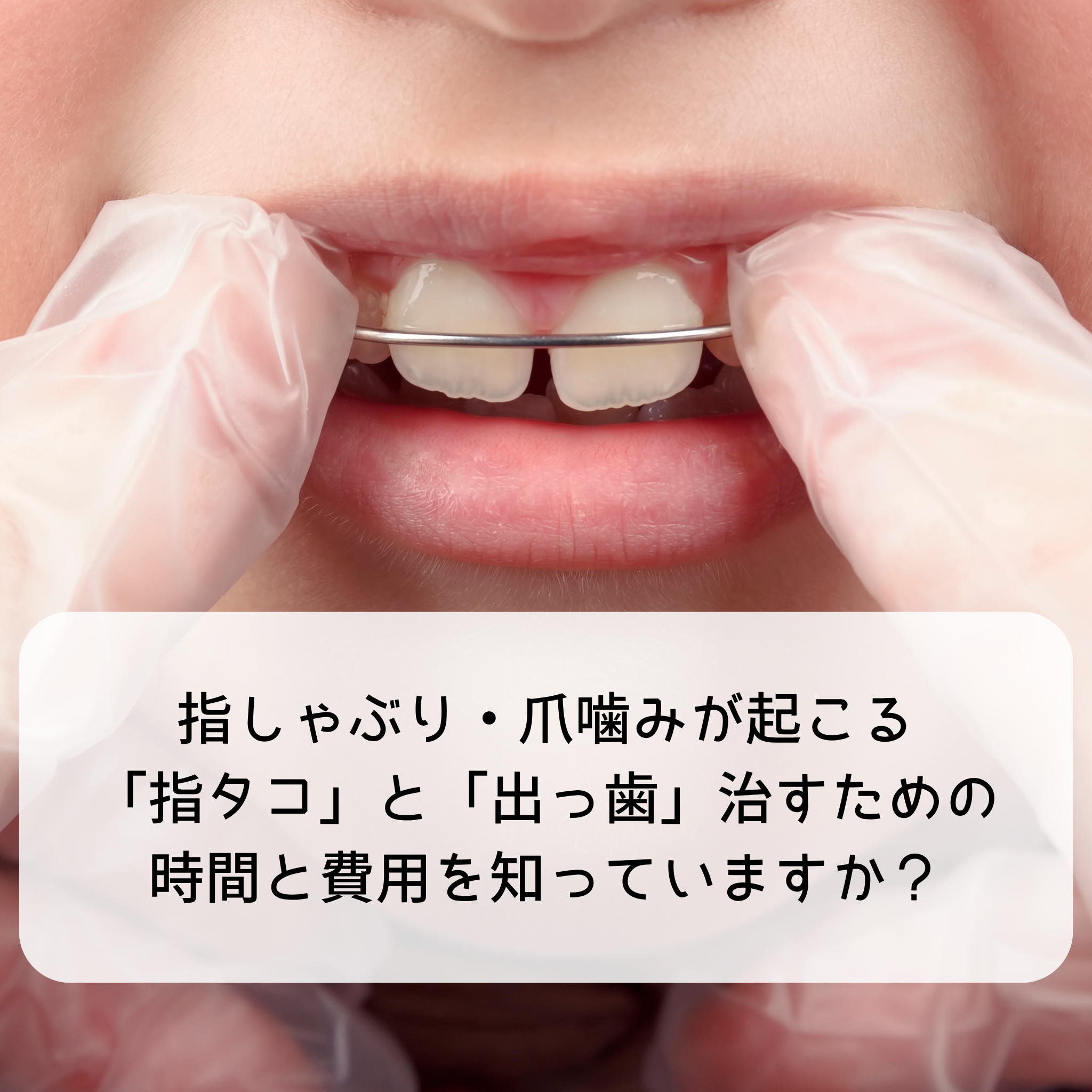 指しゃぶり・爪噛みで起こる「指タコ」と「出っ歯」──治すための時間と費用を知っていますか？